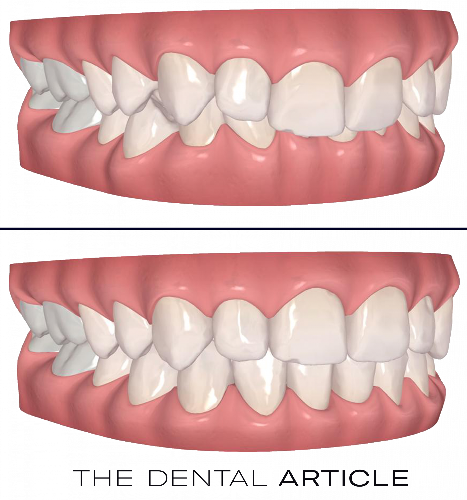 invisalign before and after