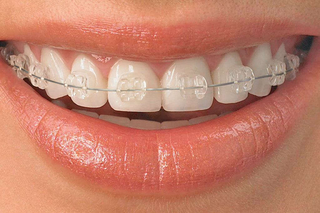 - The Dental Article https://www.manchesterorthodontics.co.uk/cdn/shop/products/ceramic-braces2.jpg?v=1559819473