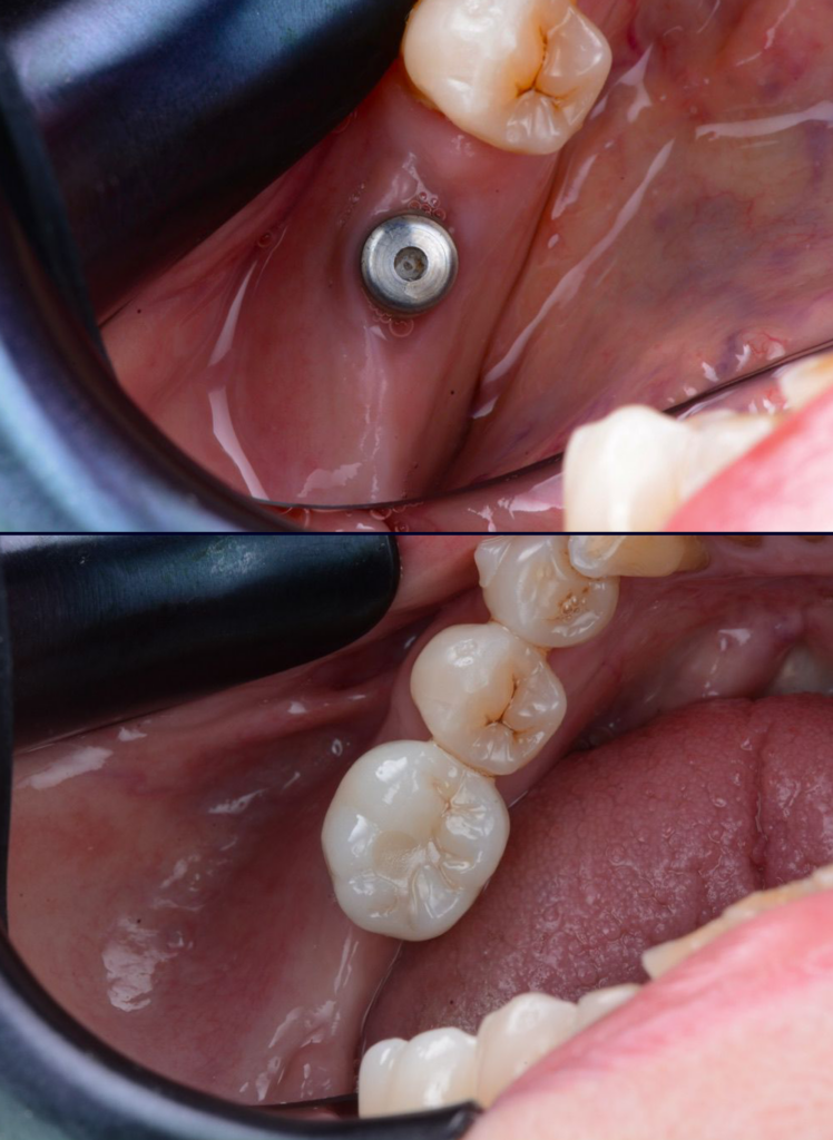 implanttest